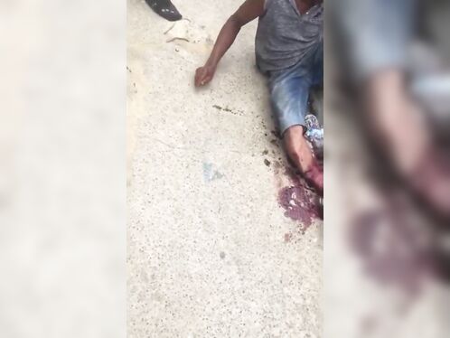 Man Shocked As He Tries To Sew His Severed Leg Back Together