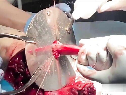 A Leg Injured By A Landmine Was Amputated