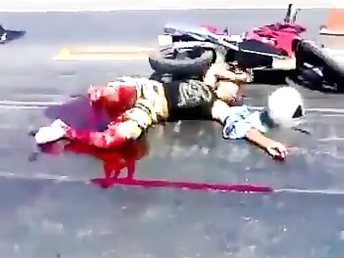 A Horrific Accident Resulted In A Cut On The Leg