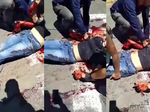 As A Result Of The Accident, The Man's Arm Was Hanging On The H