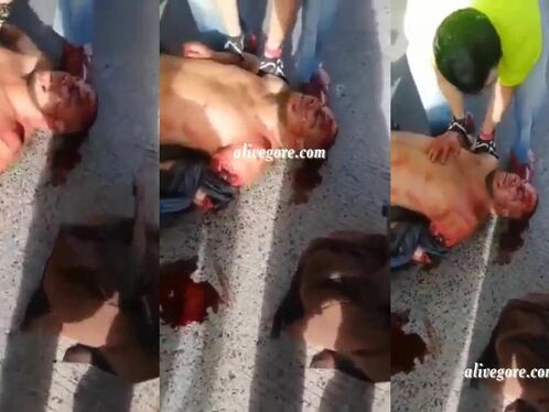 A Man's Arm Was Torn Off In An Accident