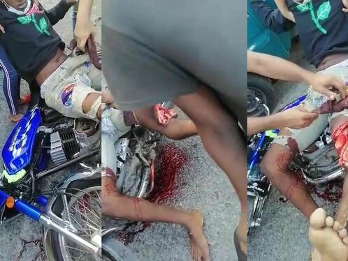 Man Loses Leg In Traffic Accident