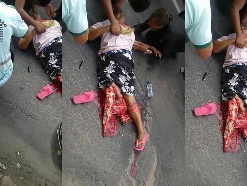 Woman Breaks Leg After Murder