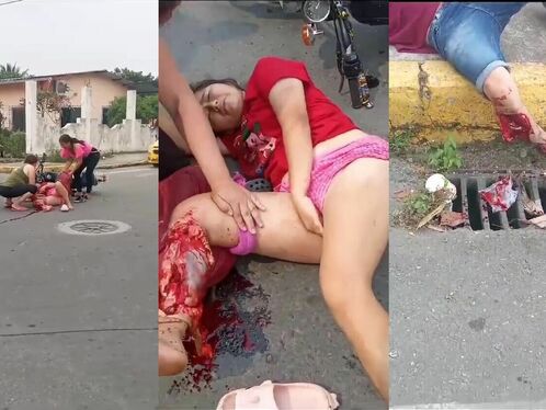 Young Woman Breaks Her Leg While Riding A Motorcycle