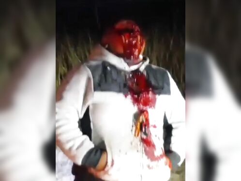 Man Remains Relaxed After Losing Both Eyes In Accident