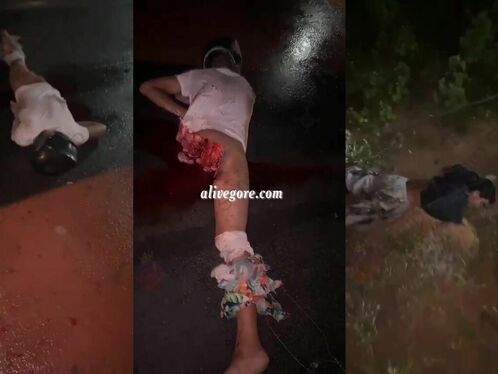 As A Result Of The Accident, The Man Lost One Of His Legs